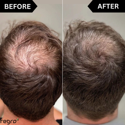 Regro™ Hair Regrowth Kit