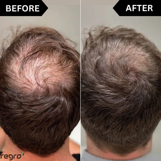 Regro™ Hair Regrowth Kit