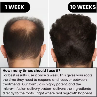 Regro™ Hair Regrowth Kit